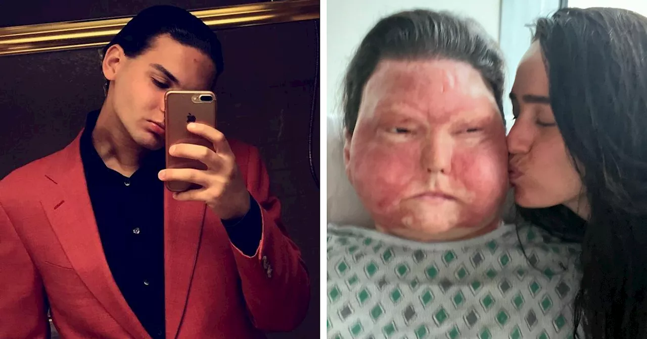 Man Who Had World’s First Face And Hands Transplant Shares Engagement Photos With Fiancée