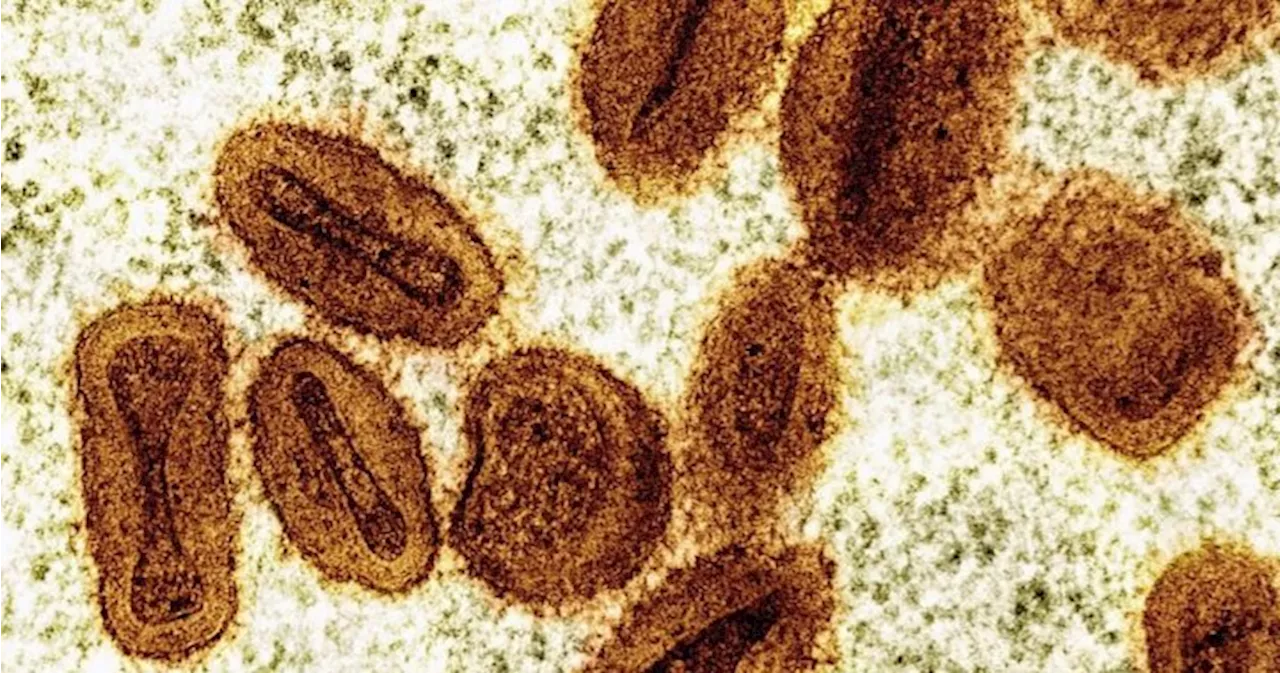 1st U.S. case of severe mpox strain confirmed in traveller: health officials