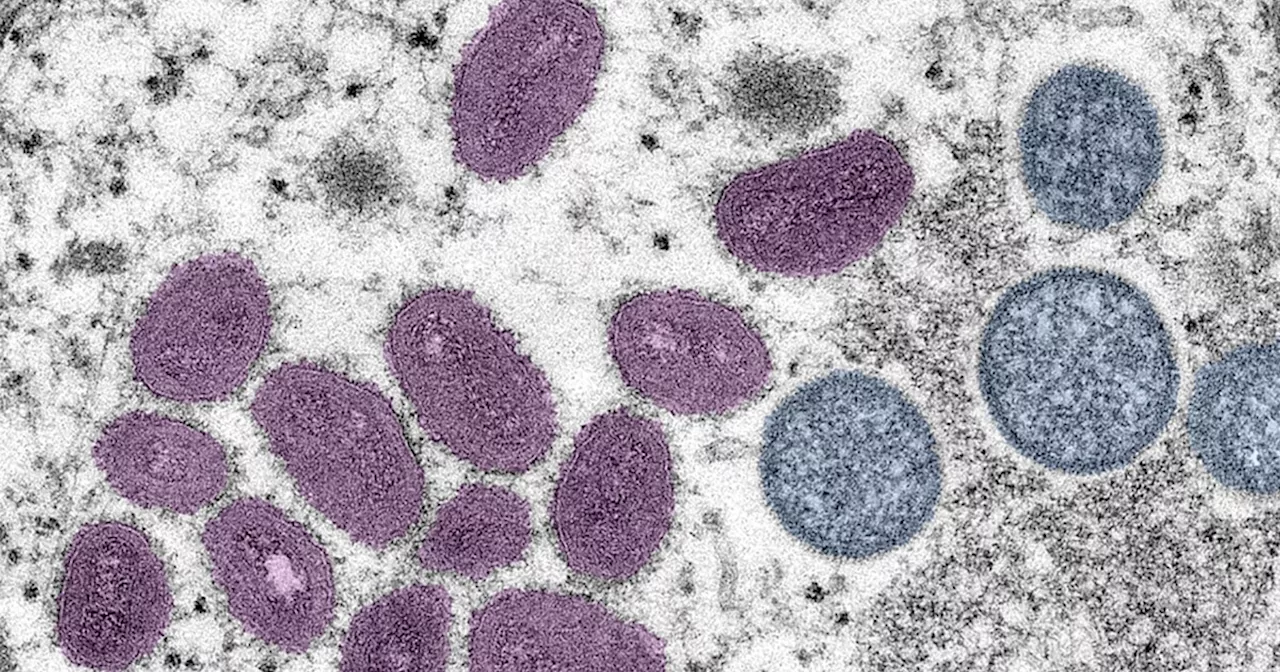 A more severe strain of mpox has been detected in the U.S. for the first time