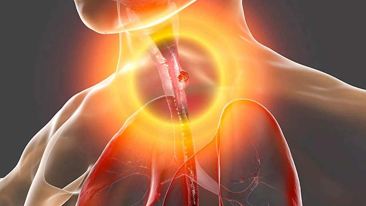 Which Therapies Improve Survival Most in Esophageal Cancer?