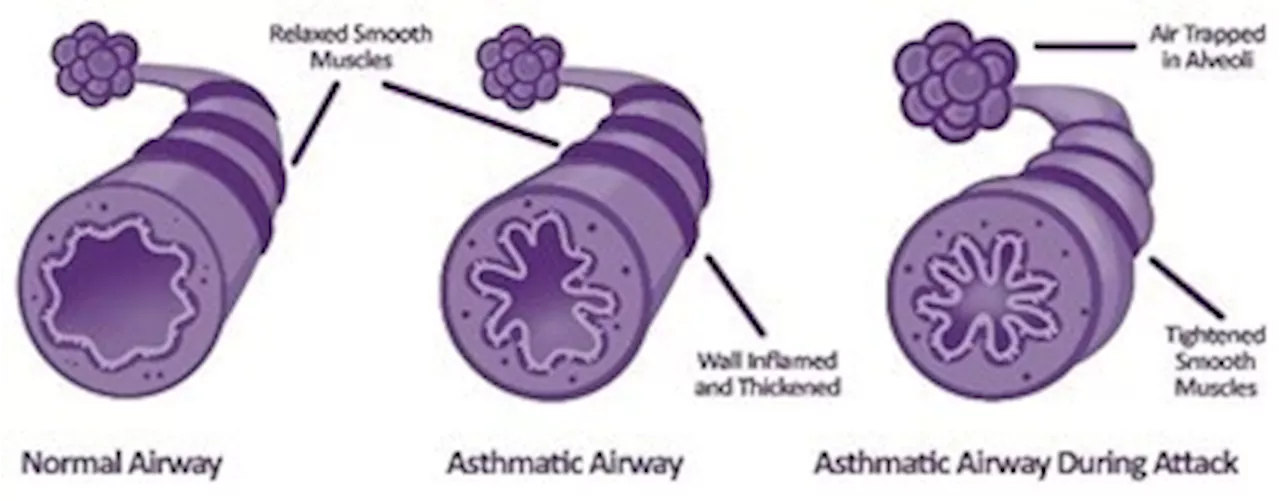 Managing asthma in children