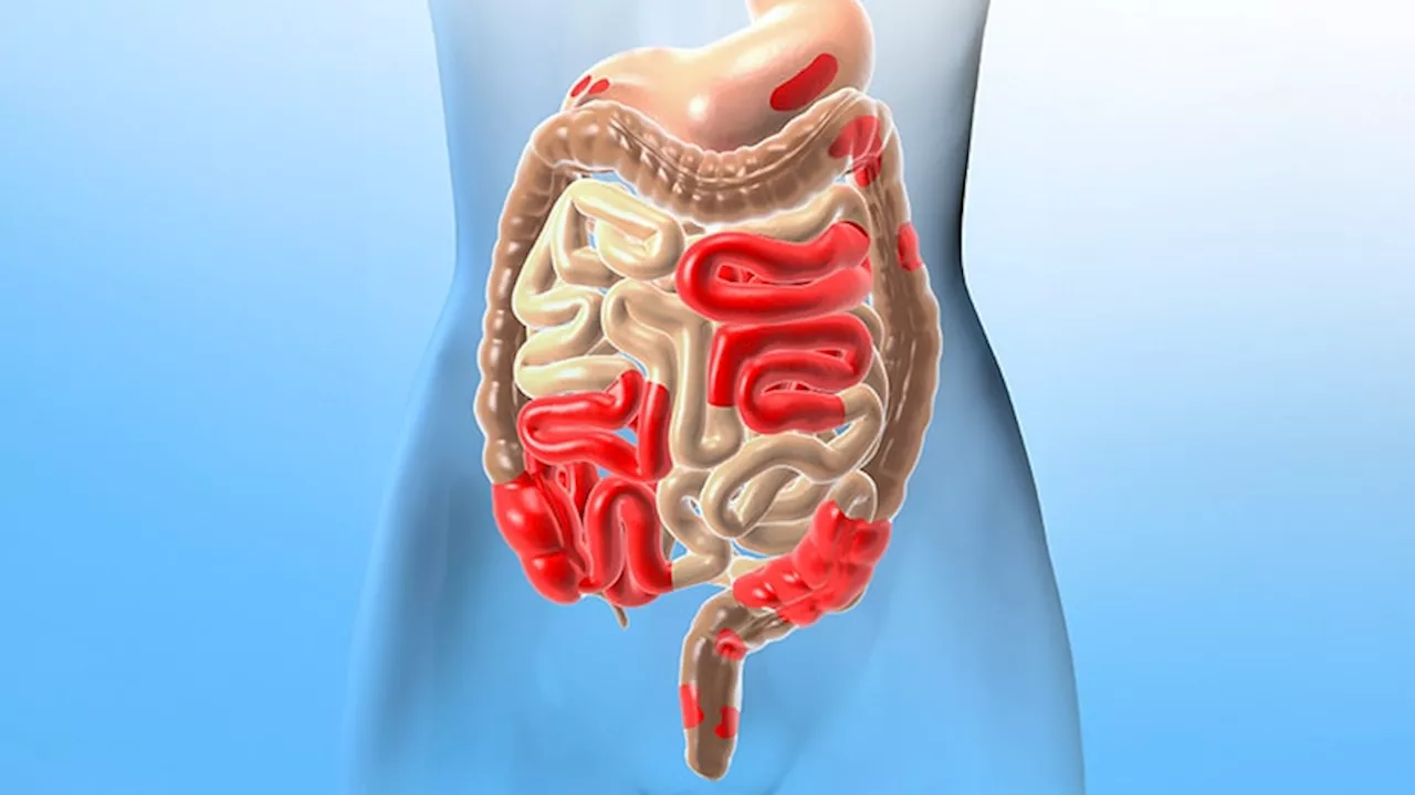 In IBD Patients, No Increased Risk for MACE Seen for JAK Inhibitors Vs Anti-TNF