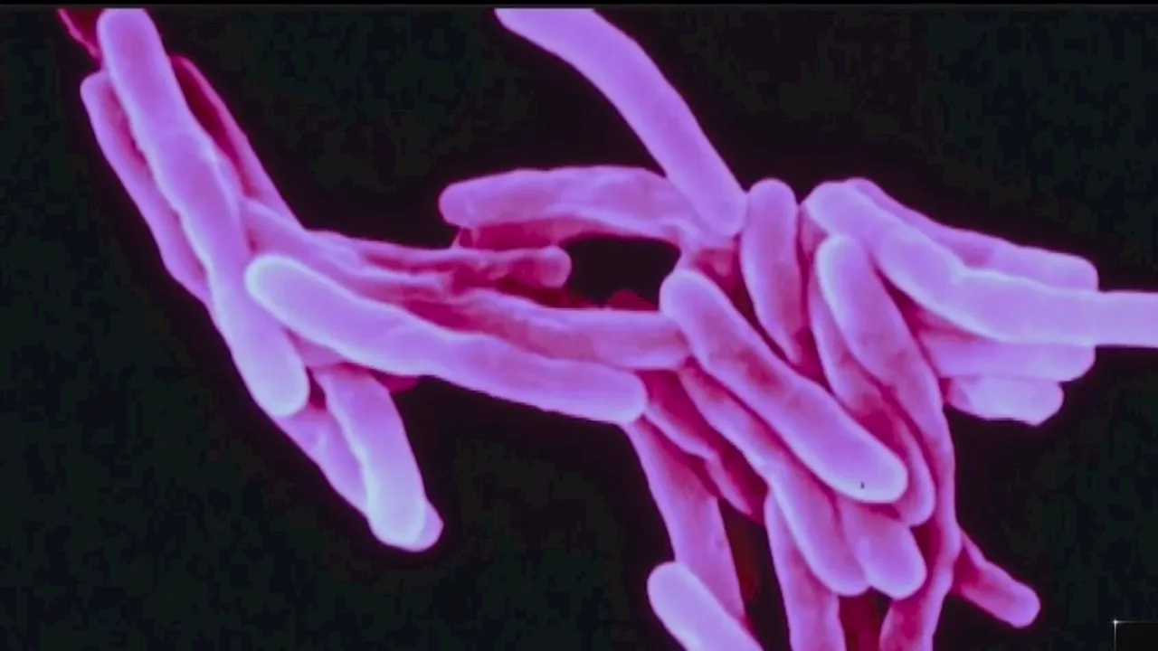 Tuberculosis case connected to Elmhurst University confirmed: officials