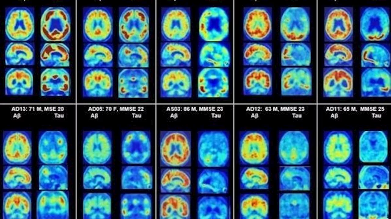 Parkinson, alzheimer, ictus y ELA son responsables del 19 % de la mortalidad en España