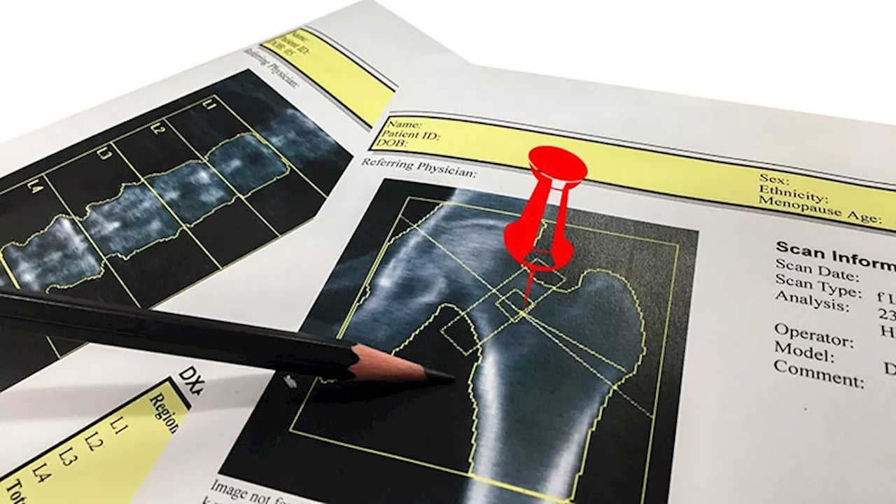 Most Older Adults With HIV Miss Bone Density Scans