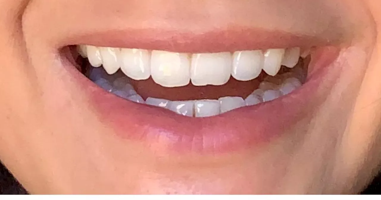 Shoppers save nearly £50 on teeth whitening kit that gives 'dentist white clean'