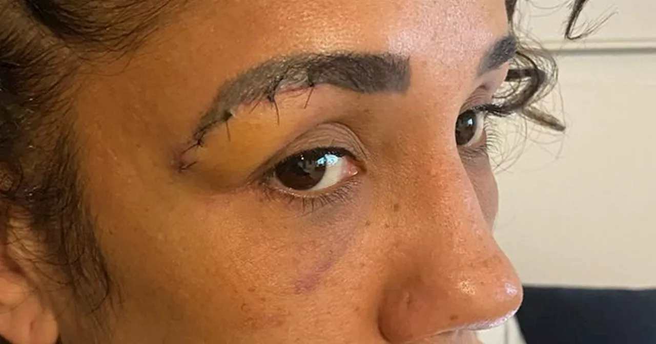 Amanda Serrano shows off battle wounds one week after Katie Taylor bloodbath