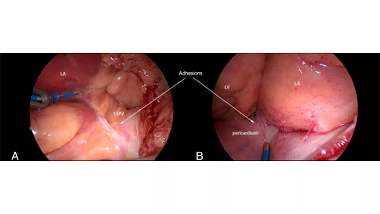 PVI Add-Ons Provide Better Control of Persistent AF