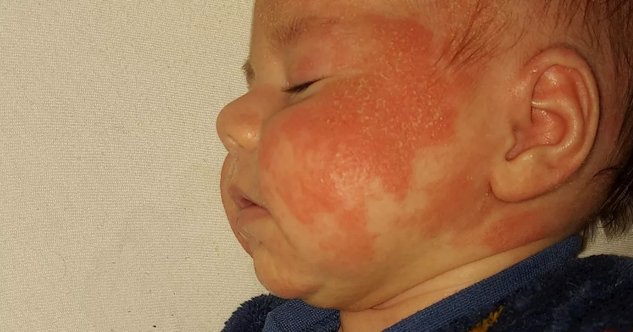 'They said son may have an allergy, weeks later he looked like a burns victim'