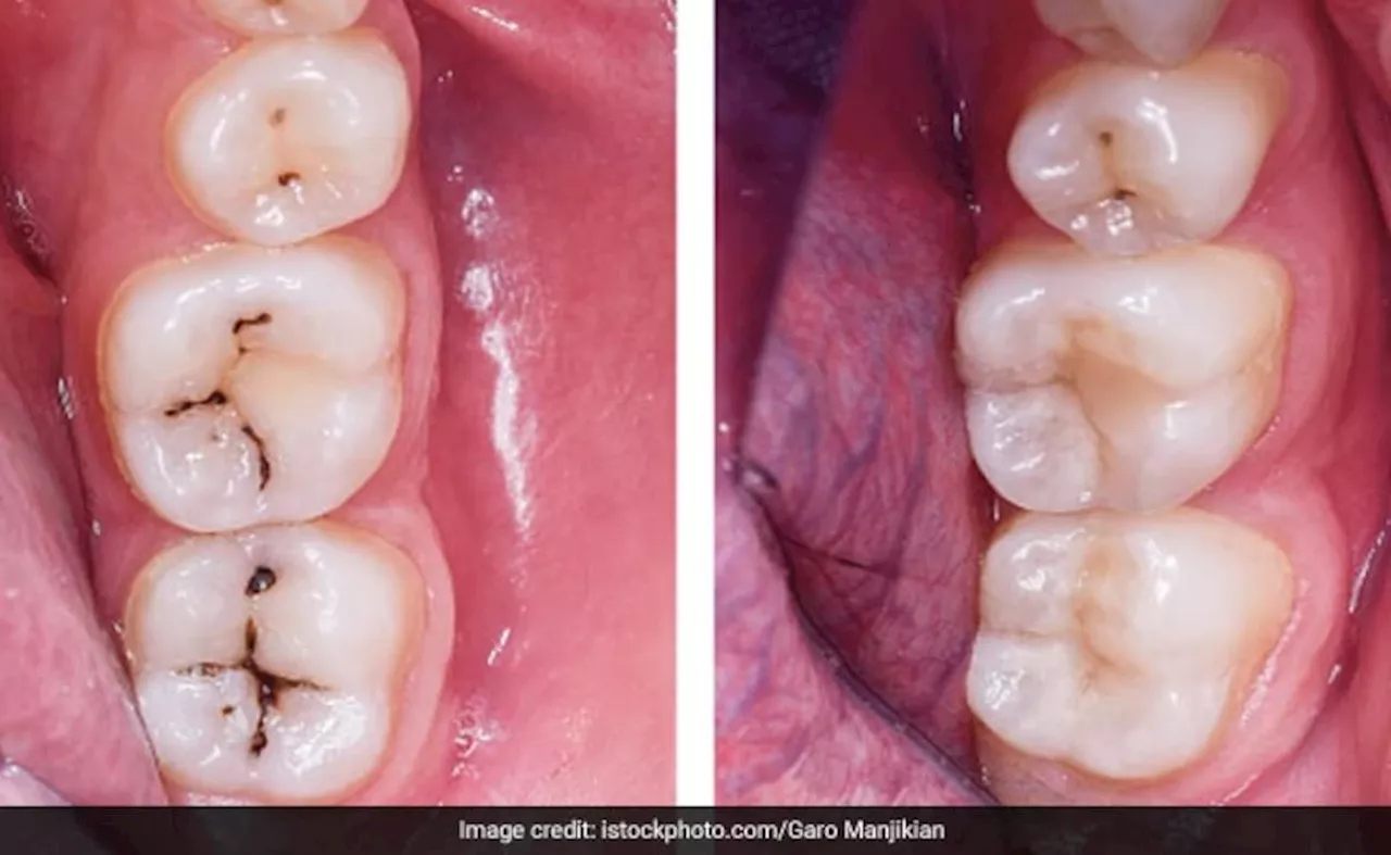 Cavity In Kids:&nbsp;कैविटी से बचाना है दांत तो चॉकलेट से पहले इस चीज से करें बच्चे को दूर, एक्सपर्ट से समझें किन चीजों से क्या आती है खराबी?