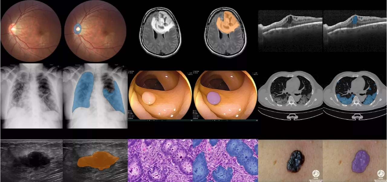 BiomedParse transforms biomedical image analysis with groundbreaking precision and scalability