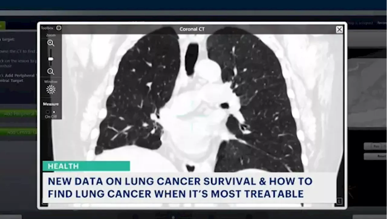 Tech advancements, new treatments fuel spike in lung cancer survival rates