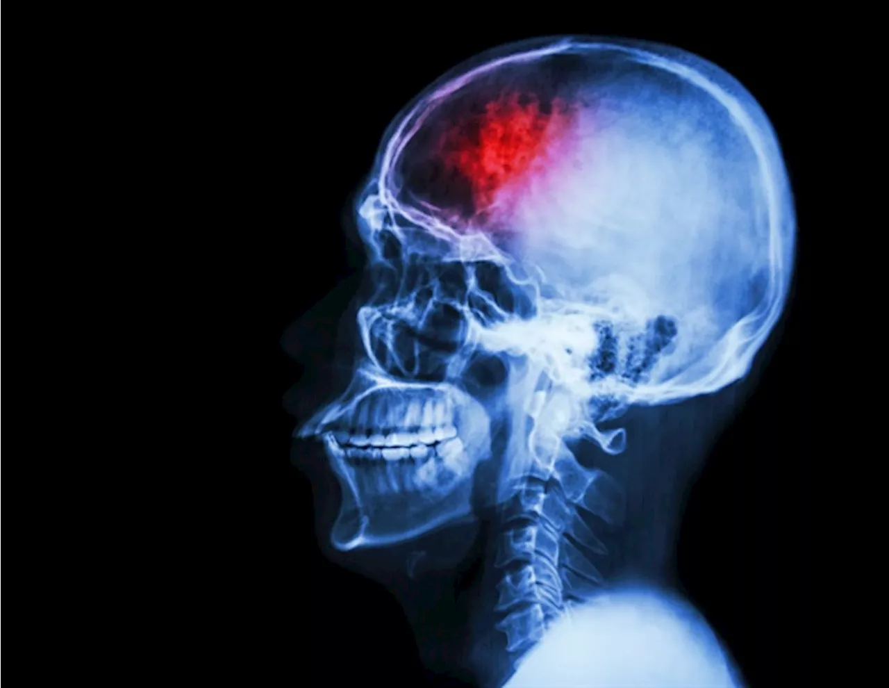 Adjunctive middle meningeal artery embolization reduces treatment failure for chronic subdural hematoma