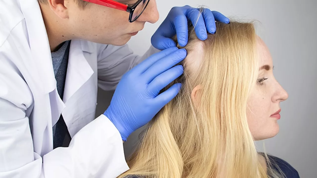 Expert Consensus Provides Clinical Guidance for Treating Hair Loss With Low-Dose Oral Minoxidil