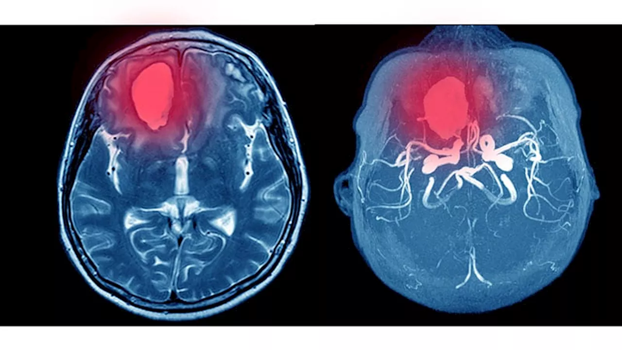 Men With Intracerebral Hemorrhage: Larger Bleeds but Better Outcomes?