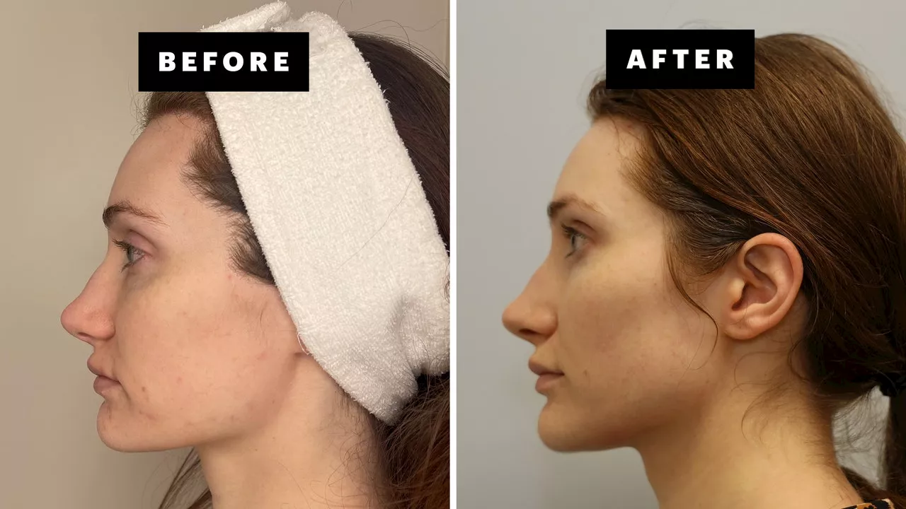 I Tried Forever Clear BBL Laser Treatment for My Chronic Acne