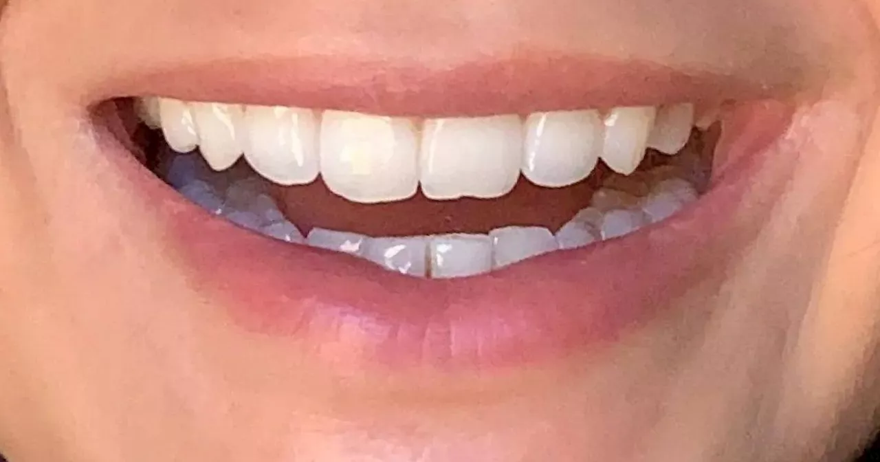 Get £50 off teeth whitening kit that gives 'dentist-white clean'