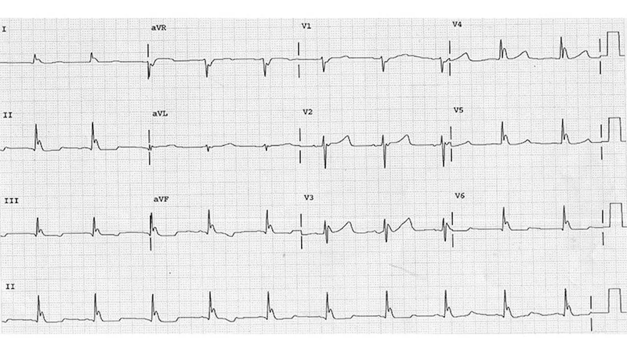 ECG Challenge: Feeling Cold and Confused