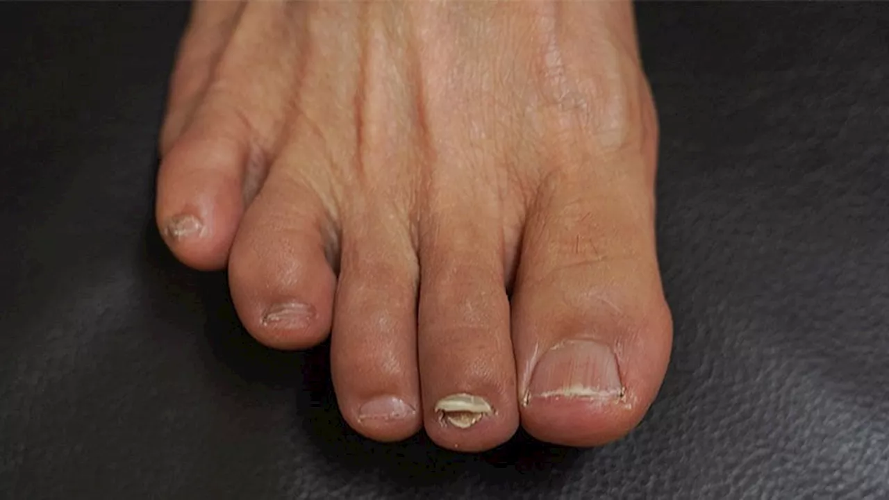 Podiatrist Shares Onychomycosis Treatment Tips