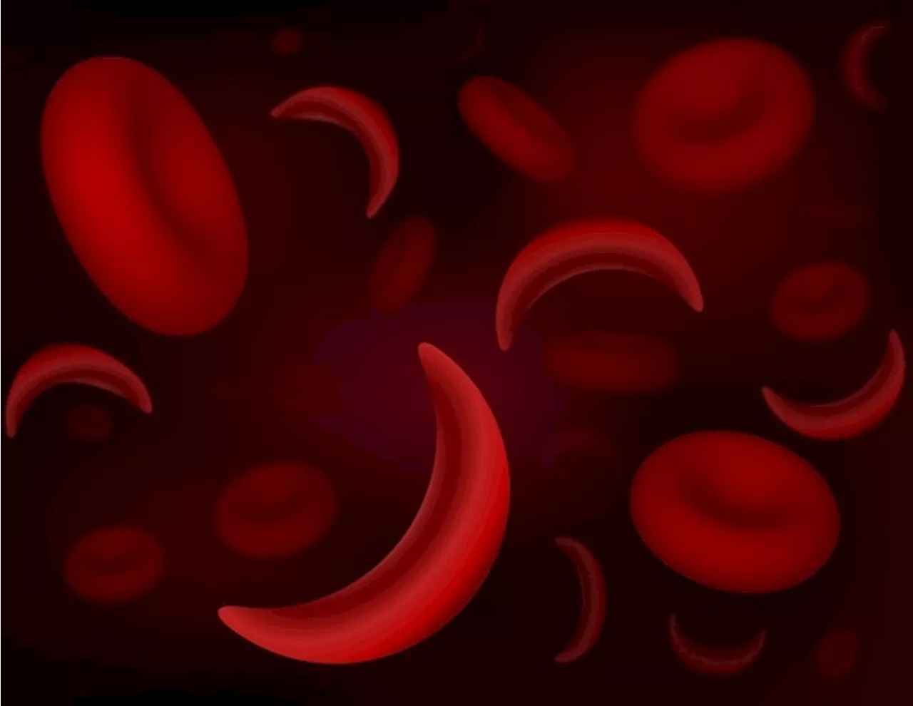 First U.S. trial uses non-viral CRISPR to correct sickle cell mutation