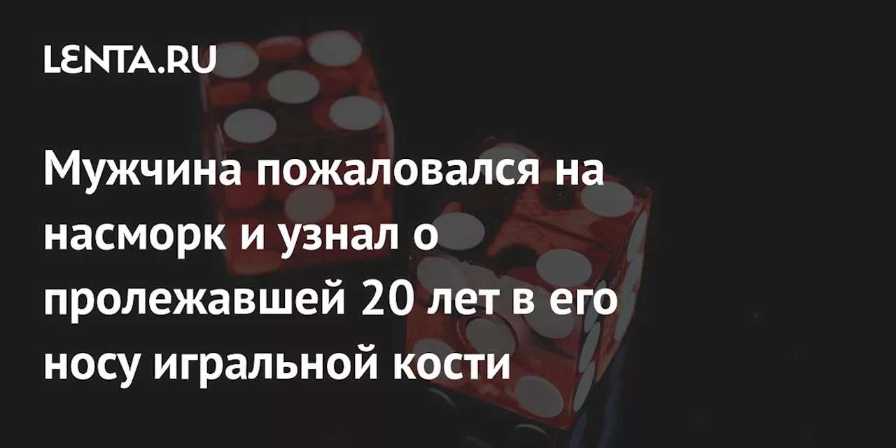 Мужчина пожаловался на насморк и узнал о пролежавшей 20 лет в его носу игральной кости