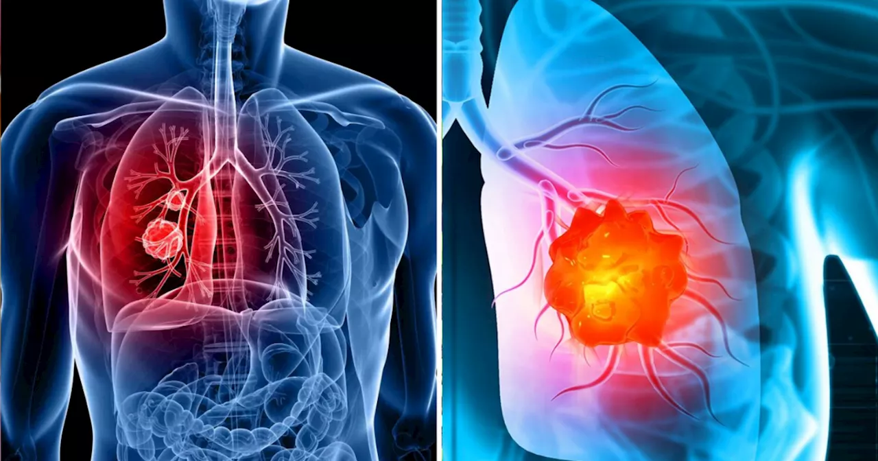 Lung Cancer Advanced Treatment: डॉ. ने बताया फेफड़ों के कैंसर का शुरुआत में पता लगाने में एडवांस डायग्नॉस्टिक्स का रोल