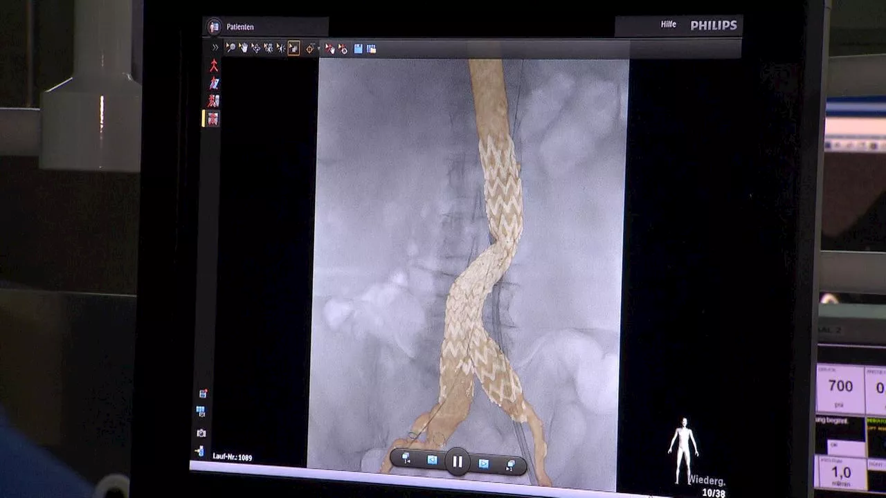 Aortenaneurysma: Symptome und OP an der Hauptschlagader