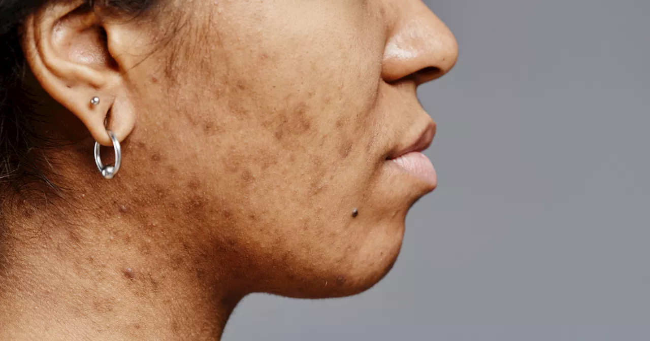 Acne scars are more visible in winter - simple tips to reduce their appearance