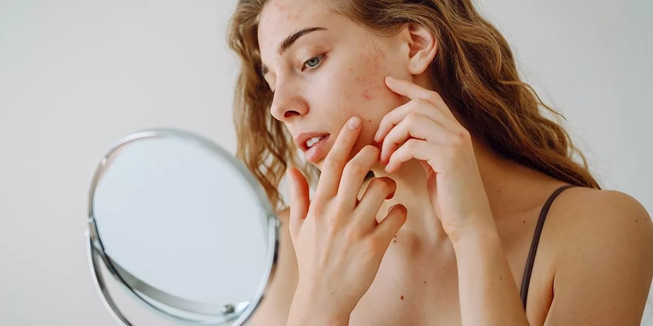 Dermatologists Warn About the No. 1 Cause of Adult Acne