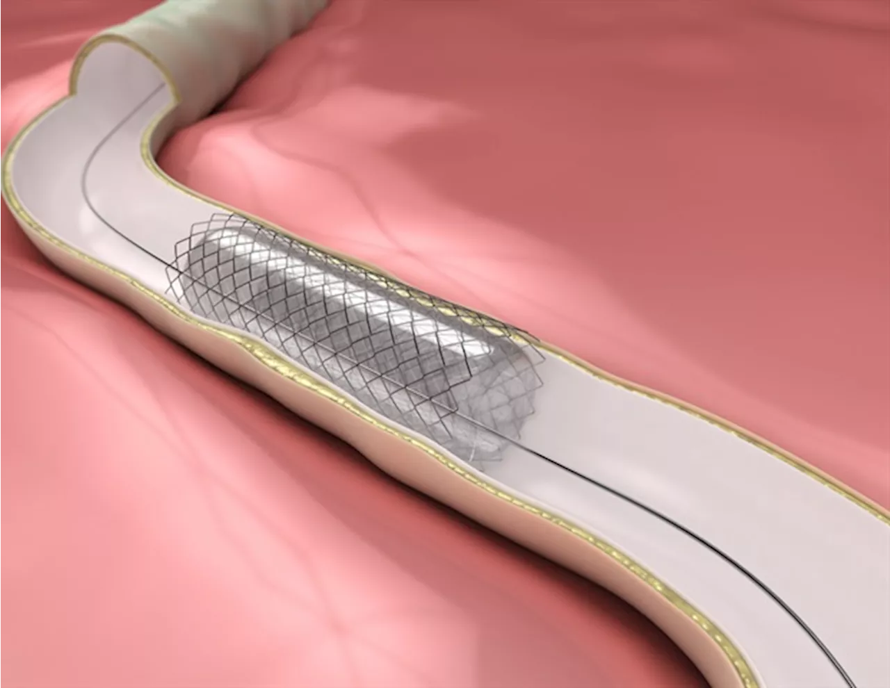 New stent sensor developed to detect blockages early