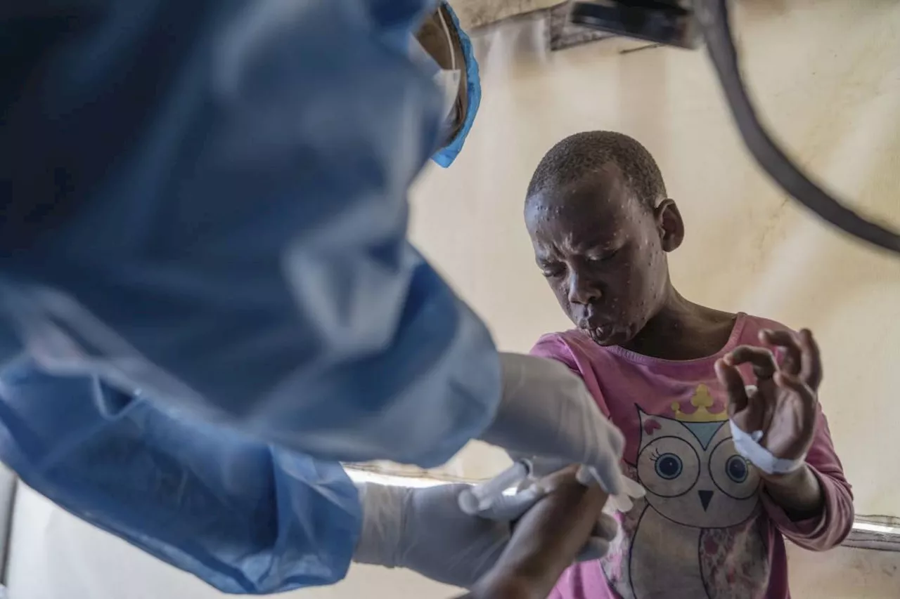 Mpox cases in Congo may be stabilizing, experts say more vaccines are needed to stamp out virus