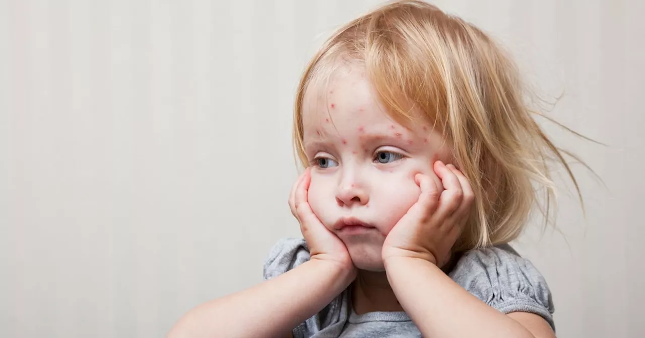 Map shows measles cases as England ravaged by worst outbreak this century