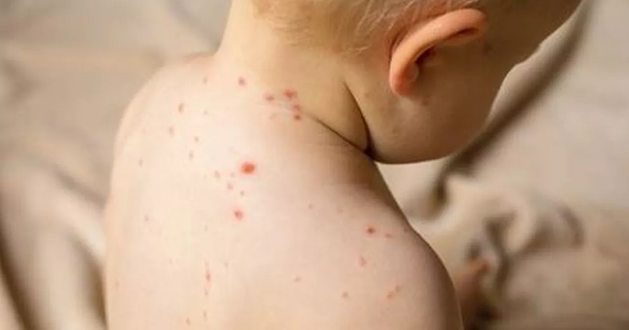 Map shows measles hotspots in Yorkshire as worst outbreak ravages country