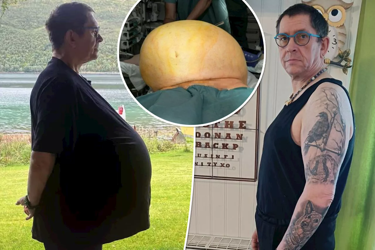 Man dismissed as 'fat' and given Ozempic before doctors find 60-pound tumor in his belly