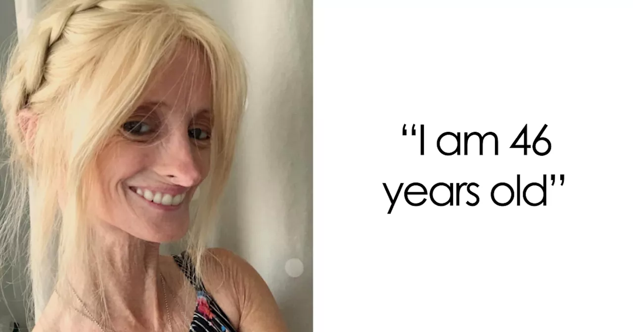 Woman, 46, With Rare 'Benjamin Button' Condition Claps Back At Trolls, Conspiracy Theorists