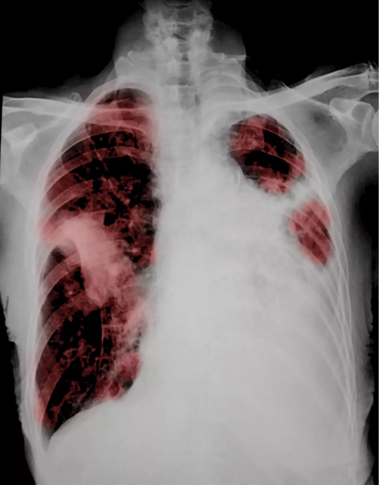 Tos persistente y falta de aire: Conozca las señales del cáncer de pulmón de células no pequeñas