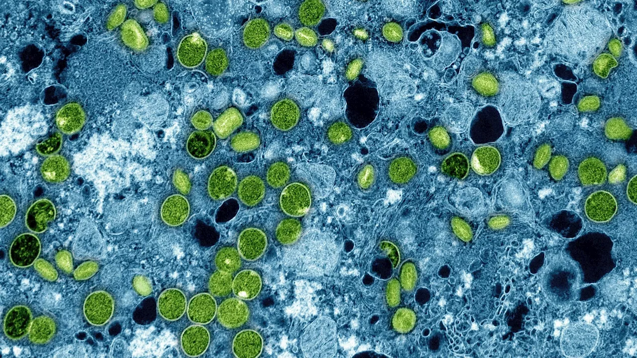 UK identifies 4 cases of new mpox variant, the 1st cluster outside Africa