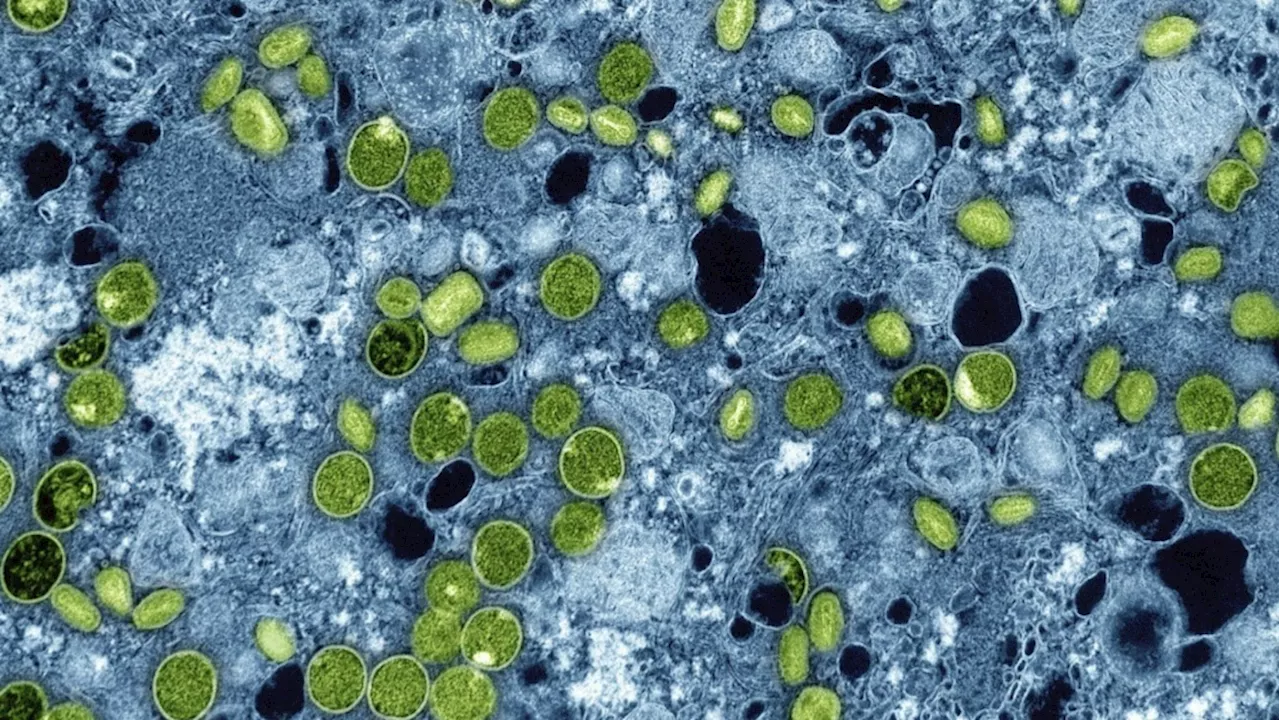 U.K. identifies 4 cases of new mpox variant, the first cluster outside Africa