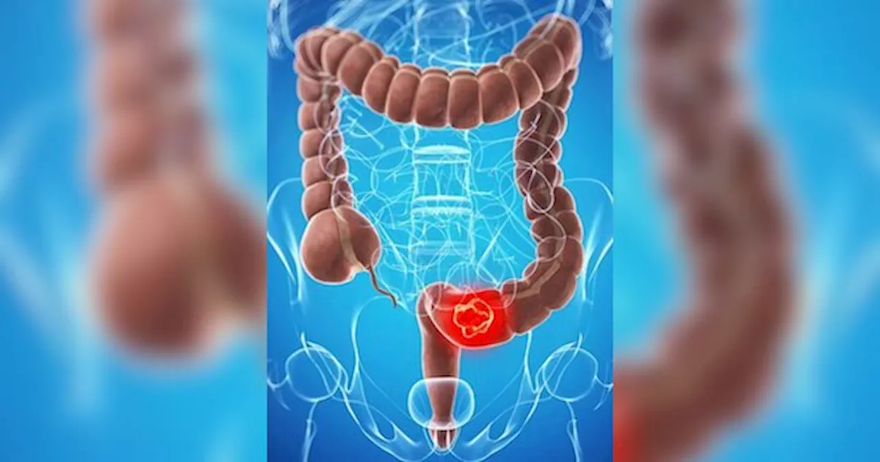कोलन कैंसर क्या है , कैसे होता है ये भयानक बीमारी