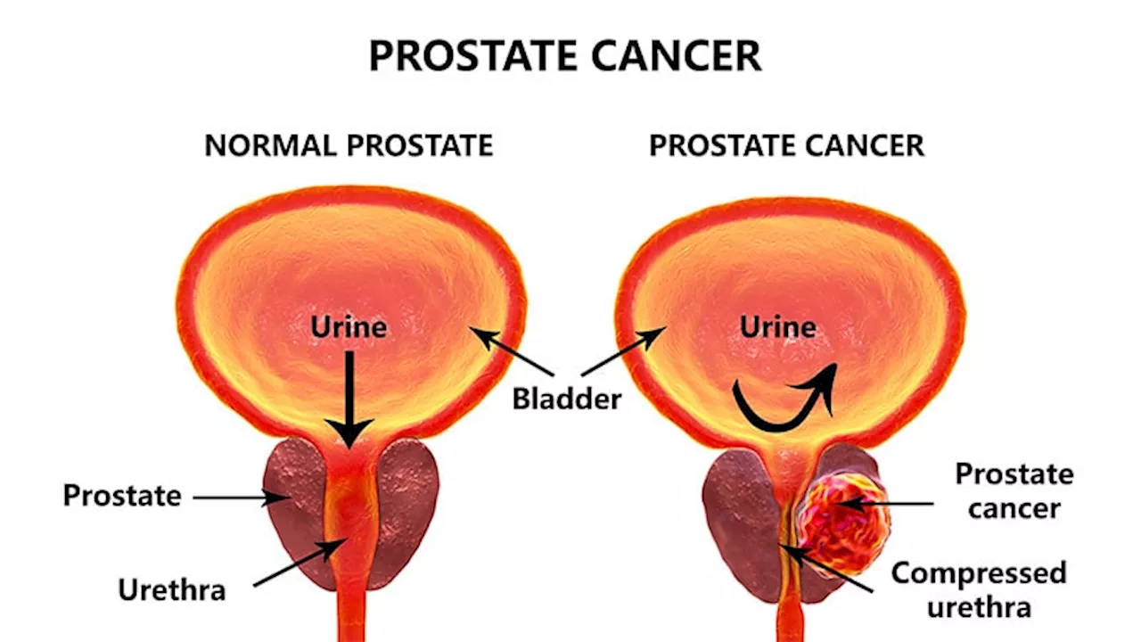 Prostate Cancer Treatment Associated With More Complications