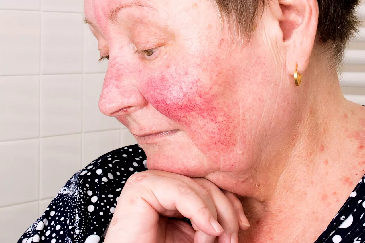 New Rosacea Treatment Option Approved by the FDA