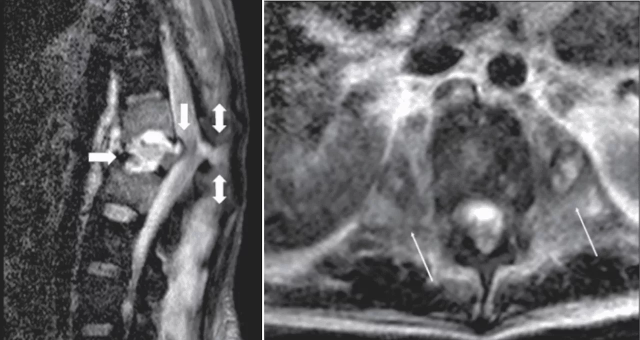 Hombre con fracturas e infección vertebral desarrolla bacteria resistente a la mayoría de antibióticos