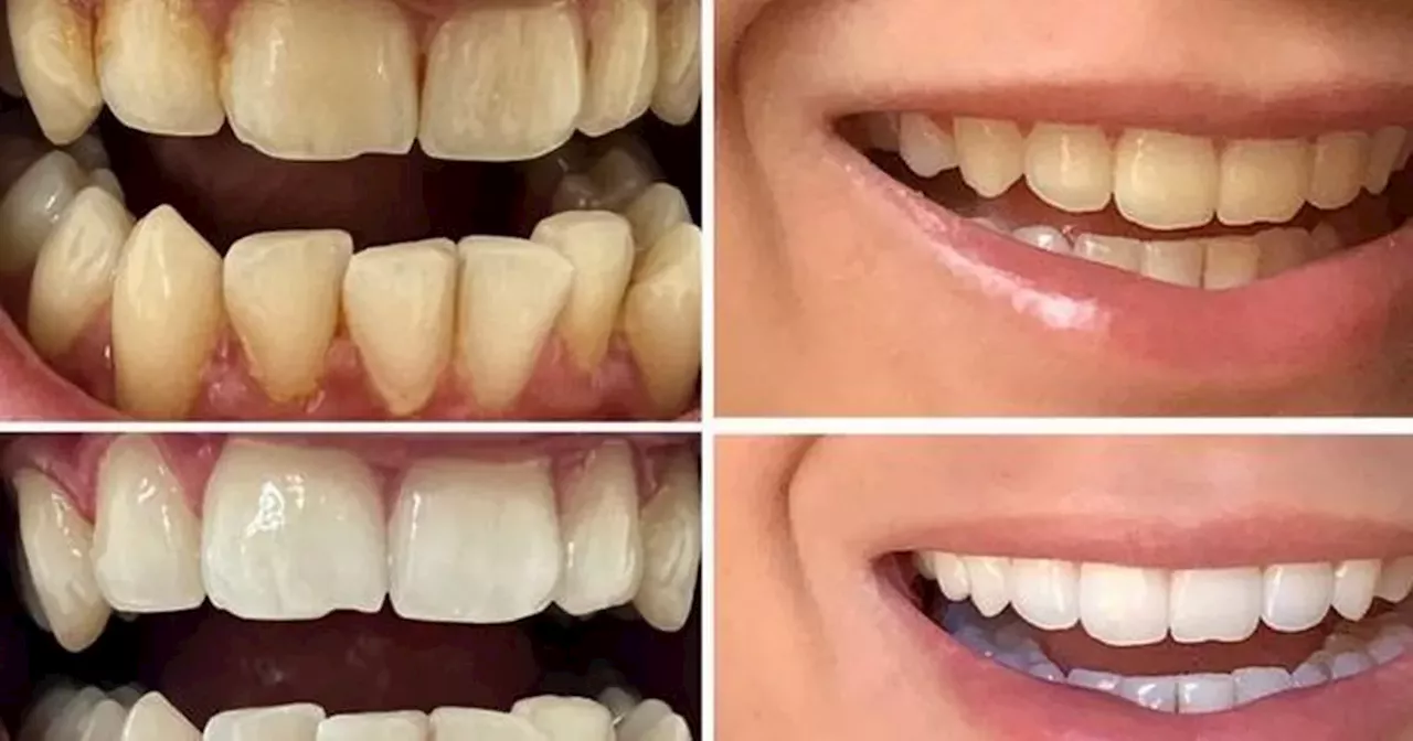 Shoppers say these teeth whitening strips 'remove stains' in a week