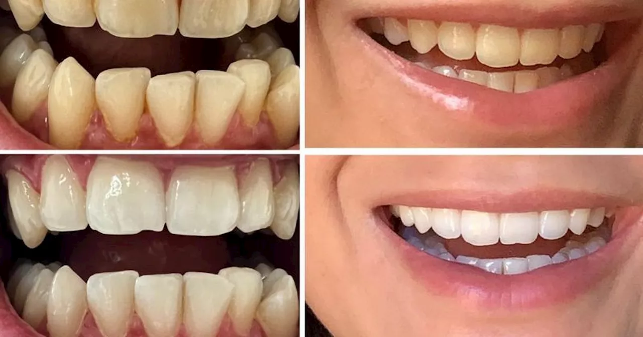 I tried teeth whitening strips that removed stains in a week