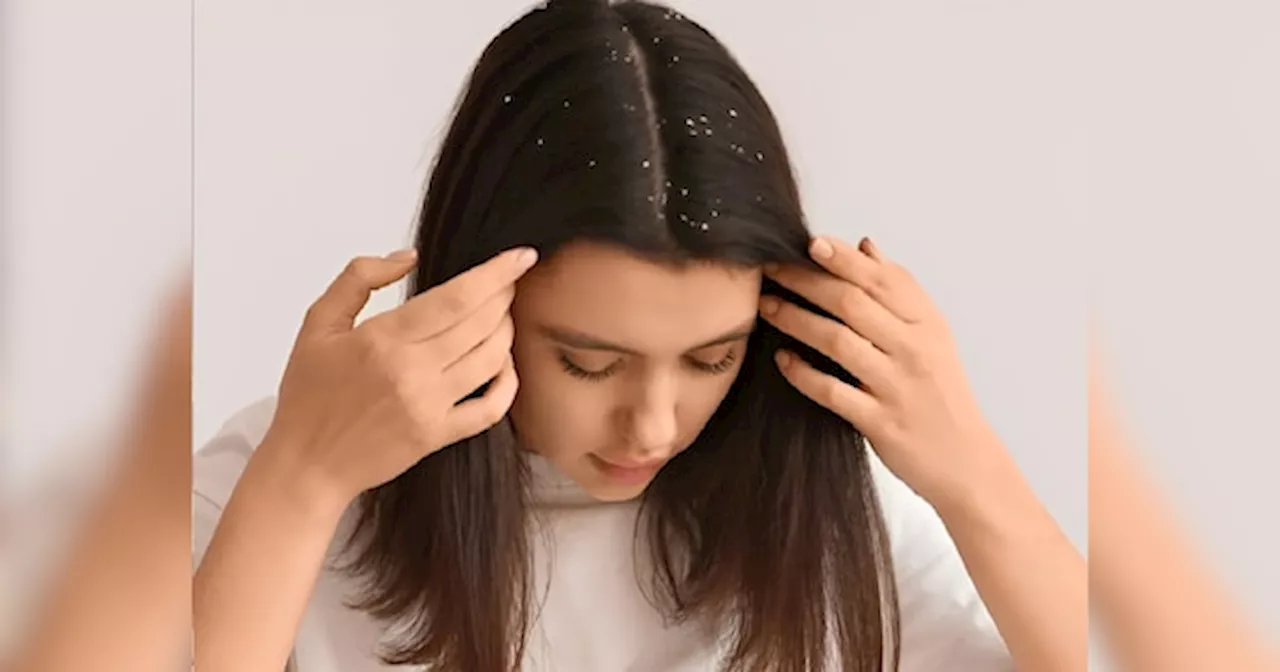 Dandruff Home Remedies: ठंड में डैंड्रफ से हैं परेशान? अपनाएं ये 10 जादुई और कारगर घरेलू उपाय