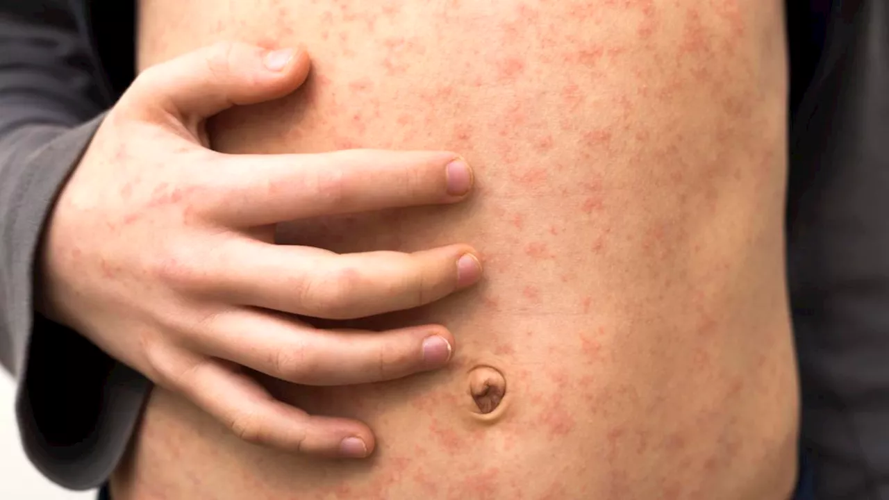 WA Health issues measles alert after returned travel visits several healthcare sites while infected