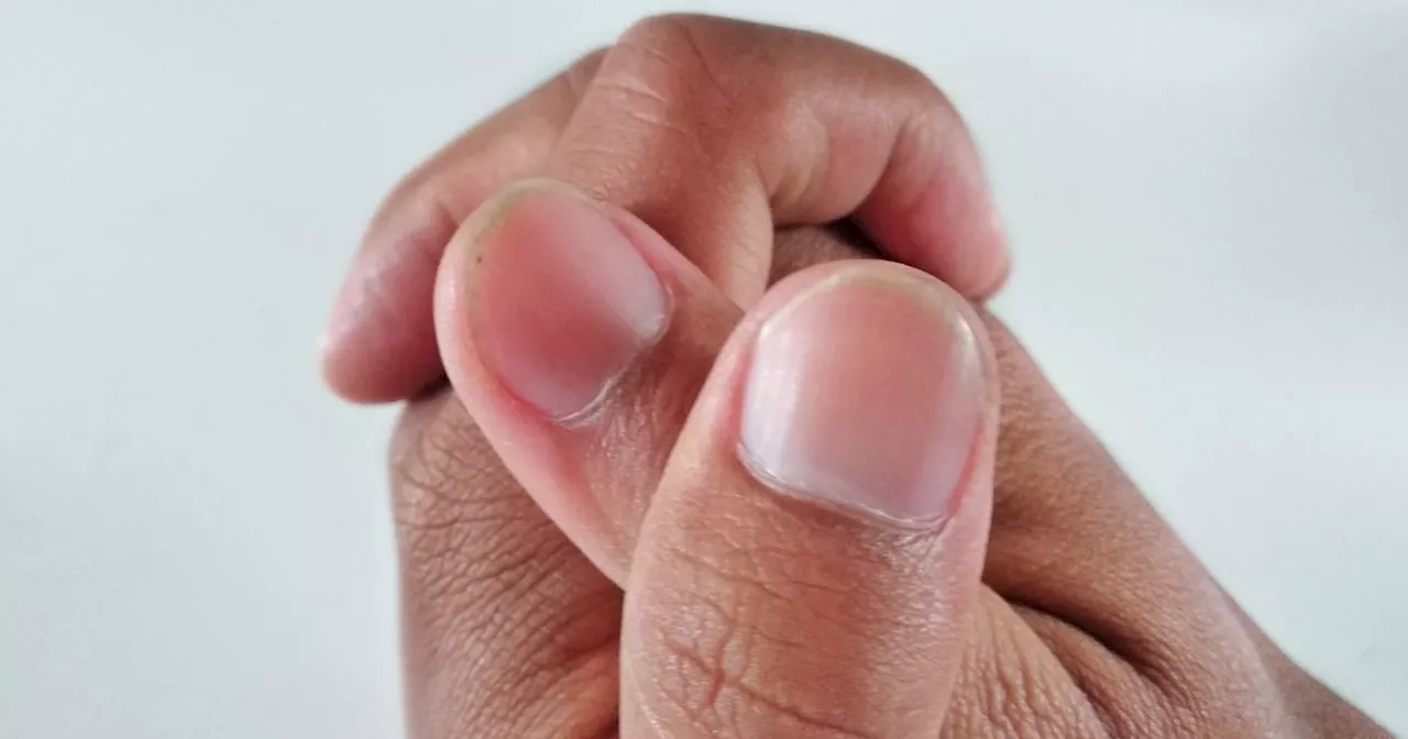 People could be missing unusual sign of heart disease on nails, doctor warns