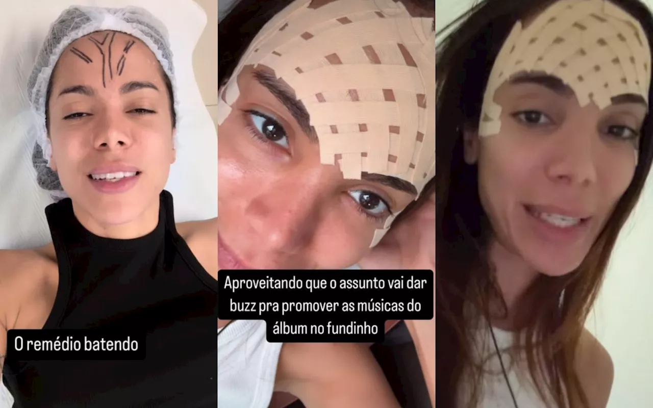 Anitta realiza procedimento estético na testa: 'Veia se foi'