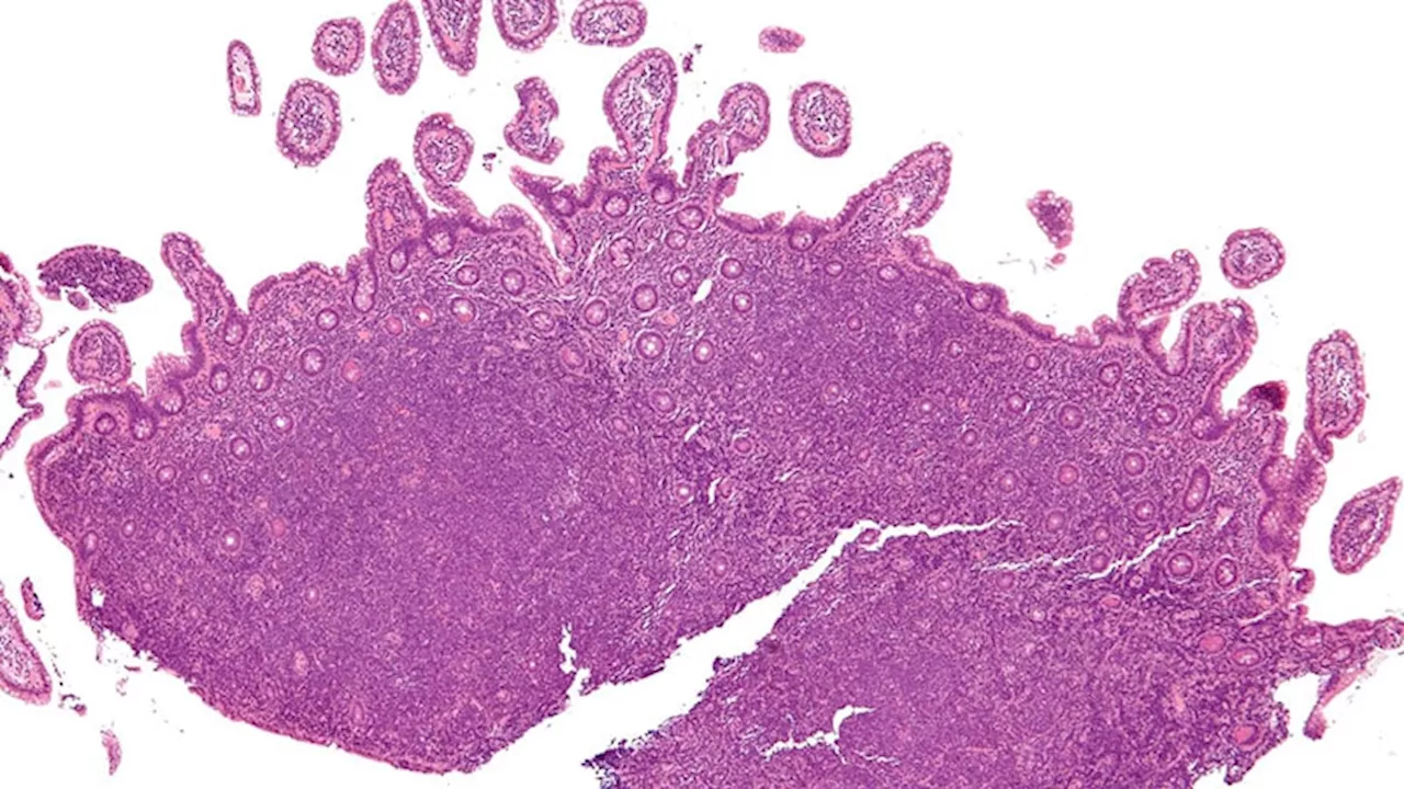 Does Acalabrutinib Fit Into Frontline MCL Therapy?