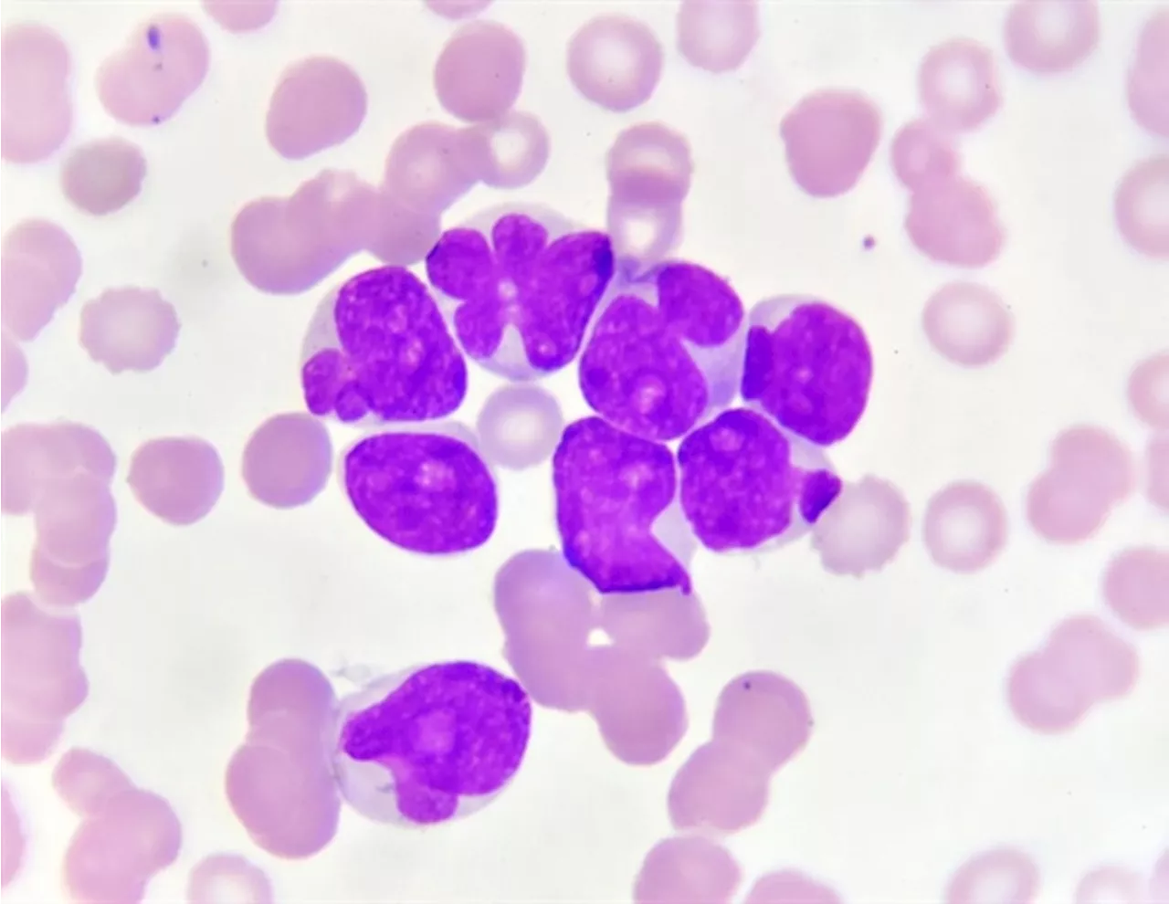 New triplet therapies show promise for relapsed and newly diagnosed leukemias